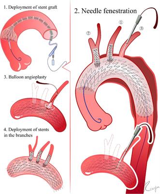 Frontiers | Technical Details Of Thoracic Endovascular Aortic Repair ...